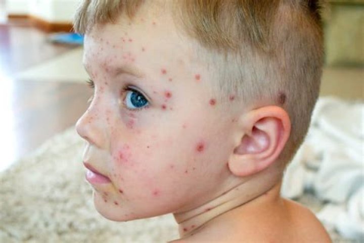 Can we eat egg in chicken pox