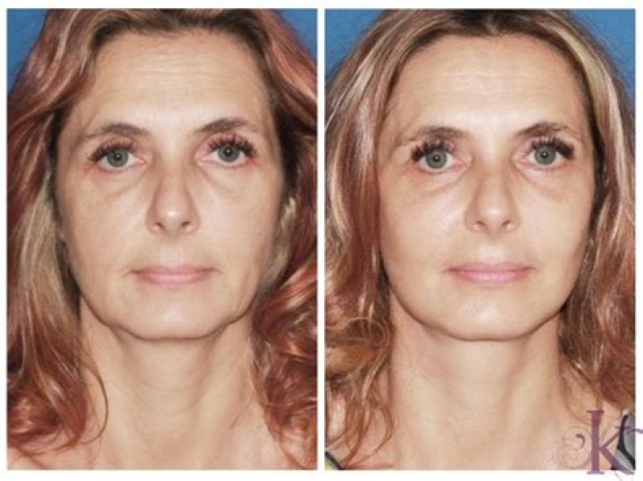 Heather Locklear Face Lift and Plastic Surgery – Weight Gain Explained