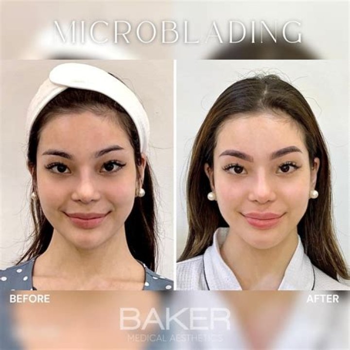 Kitty Duterte Nose Job: Before And After Surgery Photos
